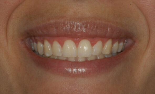 Smile Gallery. Dentist in Beverly Hills, CA. Dr. Hessam Nowzari, D.D.S., Ph.D., Dr. Eric Cho, D.D.S. Hessam Nowzari DDS, PHD