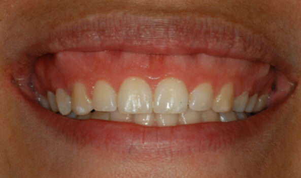 Smile Gallery. Dentist in Beverly Hills, CA. Dr. Hessam Nowzari, D.D.S., Ph.D., Dr. Eric Cho, D.D.S. Hessam Nowzari DDS, PHD