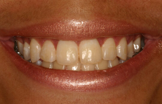 Smile Gallery. Dentist in Beverly Hills, CA. Dr. Hessam Nowzari, D.D.S., Ph.D., Dr. Eric Cho, D.D.S. Hessam Nowzari DDS, PHD