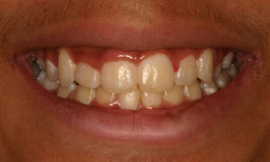 Smile Gallery. Dentist in Beverly Hills, CA. Dr. Hessam Nowzari, D.D.S., Ph.D., Dr. Eric Cho, D.D.S. Hessam Nowzari DDS, PHD