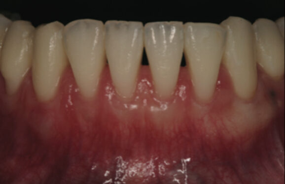 Smile Gallery. Dentist in Beverly Hills, CA. Dr. Hessam Nowzari, D.D.S., Ph.D., Dr. Eric Cho, D.D.S. Hessam Nowzari DDS, PHD