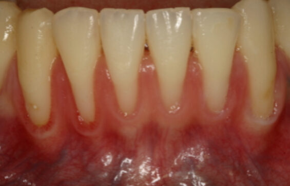 Smile Gallery. Dentist in Beverly Hills, CA. Dr. Hessam Nowzari, D.D.S., Ph.D., Dr. Eric Cho, D.D.S. Hessam Nowzari DDS, PHD