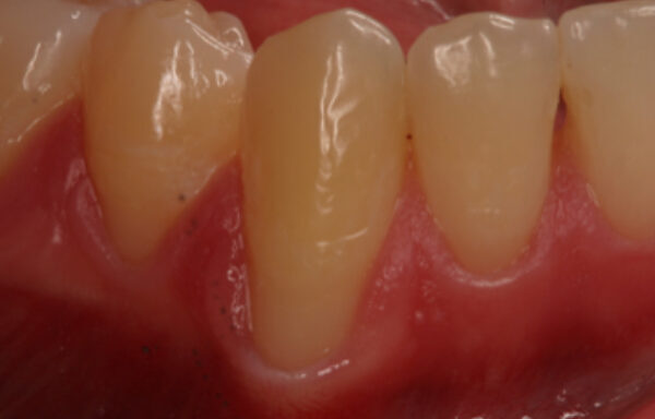 Smile Gallery. Dentist in Beverly Hills, CA. Dr. Hessam Nowzari, D.D.S., Ph.D., Dr. Eric Cho, D.D.S. Hessam Nowzari DDS, PHD
