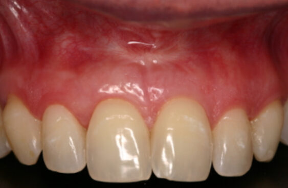 Smile Gallery. Dentist in Beverly Hills, CA. Dr. Hessam Nowzari, D.D.S., Ph.D., Dr. Eric Cho, D.D.S. Hessam Nowzari DDS, PHD