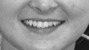 Smile Gallery. Dentist in Beverly Hills, CA. Dr. Hessam Nowzari, D.D.S., Ph.D., Dr. Eric Cho, D.D.S. Hessam Nowzari DDS, PHD