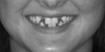 Smile Gallery. Dentist in Beverly Hills, CA. Dr. Hessam Nowzari, D.D.S., Ph.D., Dr. Eric Cho, D.D.S. Hessam Nowzari DDS, PHD